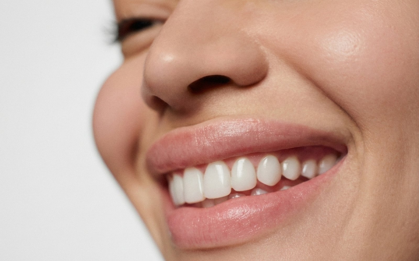 Overbite after clear aligners